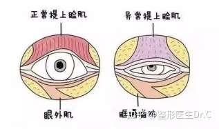 而是会缩短一部分提肌腱膜,让睁眼力量得到增强,所以眼睛就会变大