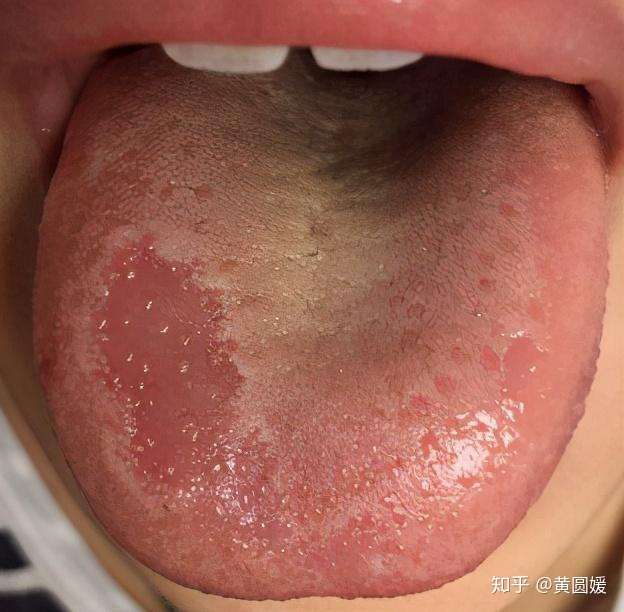 "地图舌"是一种舌黏膜疾病,又叫做花剥舌,现代医学称之为游走性舌炎