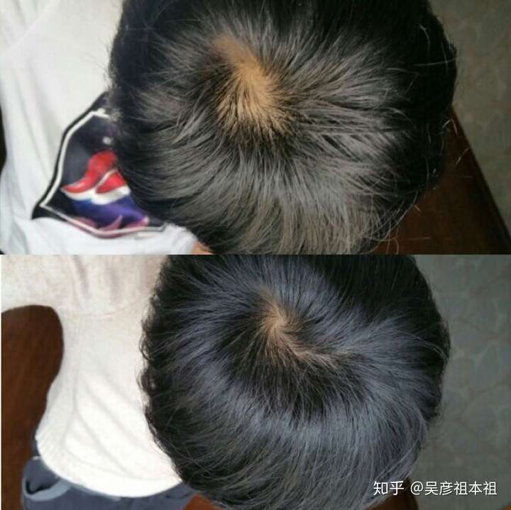 你们脱发最终是怎么好的?