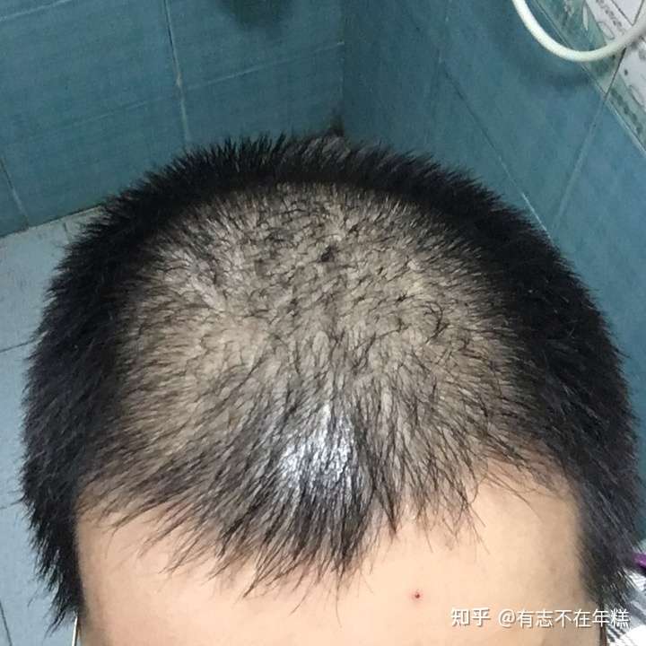 植发后6个月6天了是不是失败了