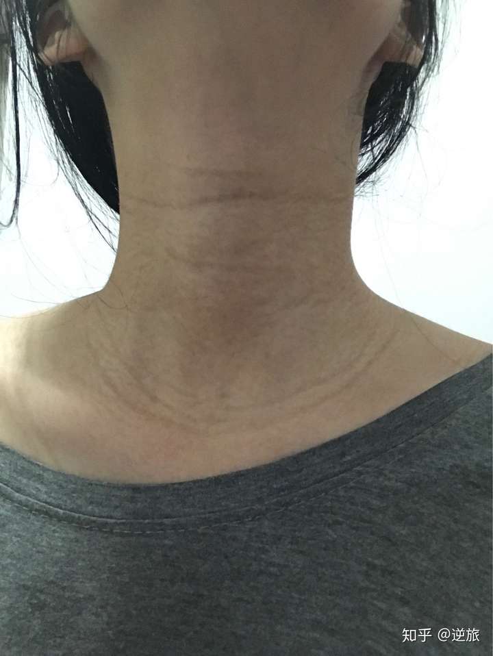 怀孕期间长的颈纹在后期会消吗