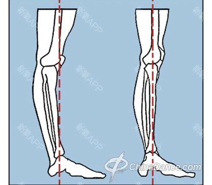 为什么腿型从侧面看大腿向前倾得厉害,小腿朝后弯曲,膝盖骨向前,是