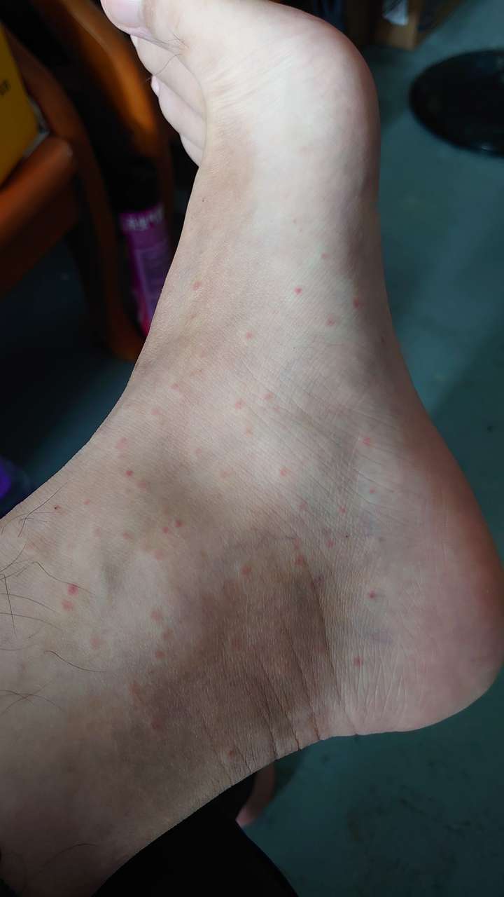 为什么有的人被蚊子咬了就出现疙瘩而且很痒,有些人就只是出现红点