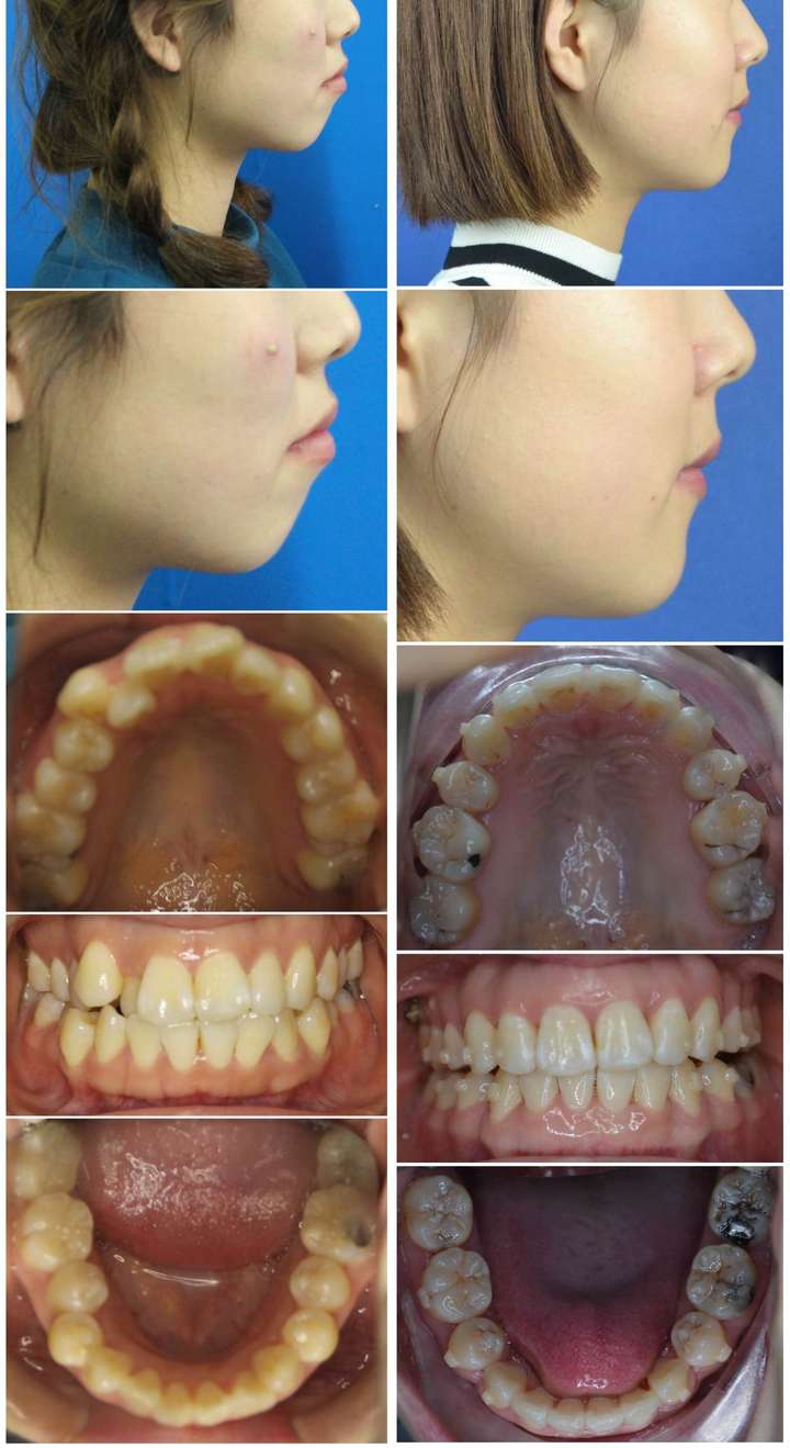 现在患者的牙齿不仅变得整齐了,颏唇沟也更加明显,笑起来侧貌也更加