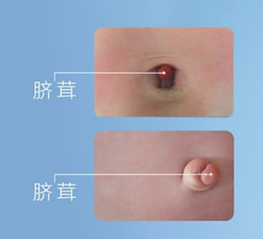 美家尔湾如何进行新生儿肚脐护理