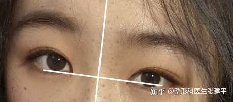 一眼高一眼低一眼大一眼小是怎么回事有什么改善方法