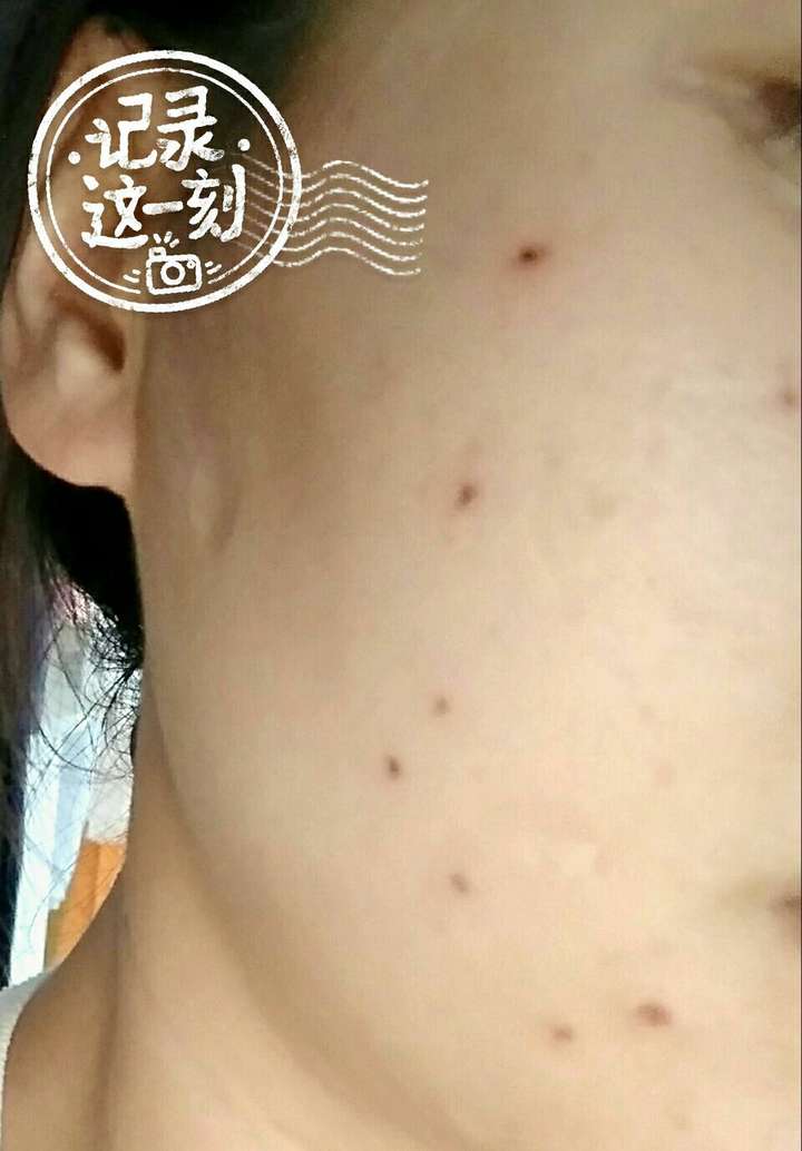 再见了,左脸边缘陪伴了我二十几年的的七星连珠痣,希望你们走好,不要