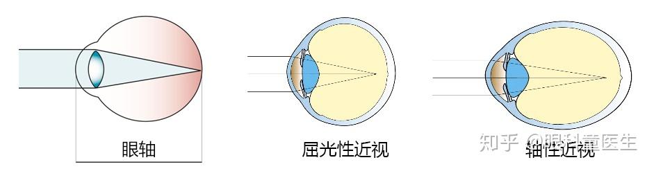 近视根据其发生的机制分为屈光性近视和轴性近视,如果两种成分都有的