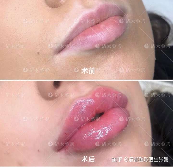 玻尿酸填充丰唇采用注射的方法将玻尿酸材料注入到唇部,通过增加