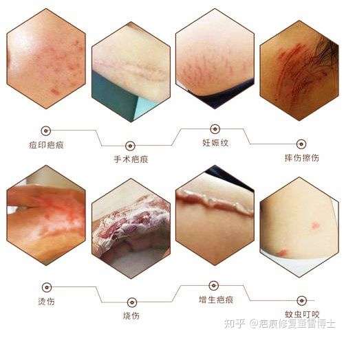 瘢痕和疤痕的区别 zhuanlan.zhihu.com