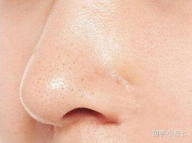 怎么去除黑头粉刺