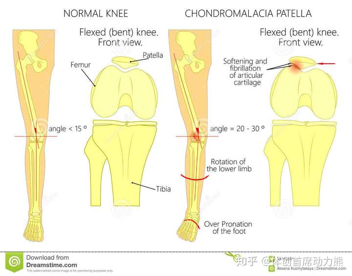 扁平足是足旋前过度,所以会造成膝盖内扣(膝外翻角度增加),股骨内旋