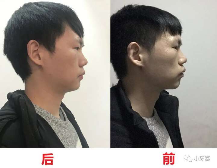 改善下巴后缩嘴凸的口周肌肉锻炼动作带练习视频