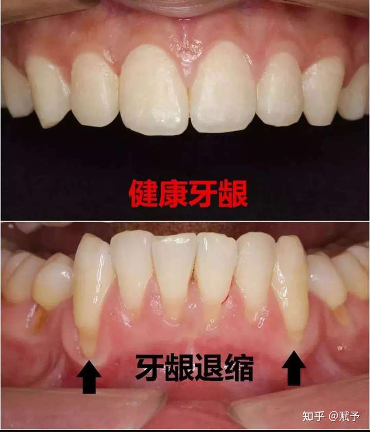 及牙龈萎缩导致牙根裸露,造成牙齿脱落,且无牙龈难于种植