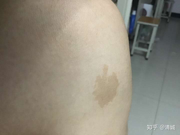 你有没有形状特别或生长位置特别的胎记?