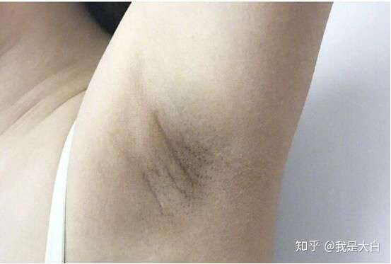 突然有狐臭怎么办 是刮腋毛的原因吗 可以用除狐臭的药吗 ?