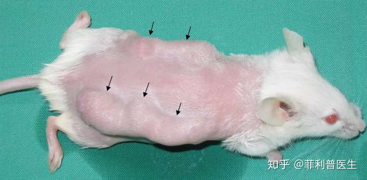 combined immunodeficient mice,重度联合免疫缺陷)小鼠接种人淋巴瘤