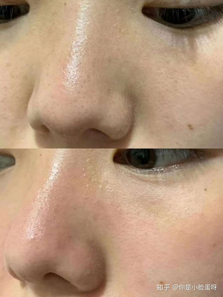 如何去除鼻子上的黑头?