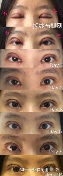 高度近视凸眼的割双眼皮经历分享