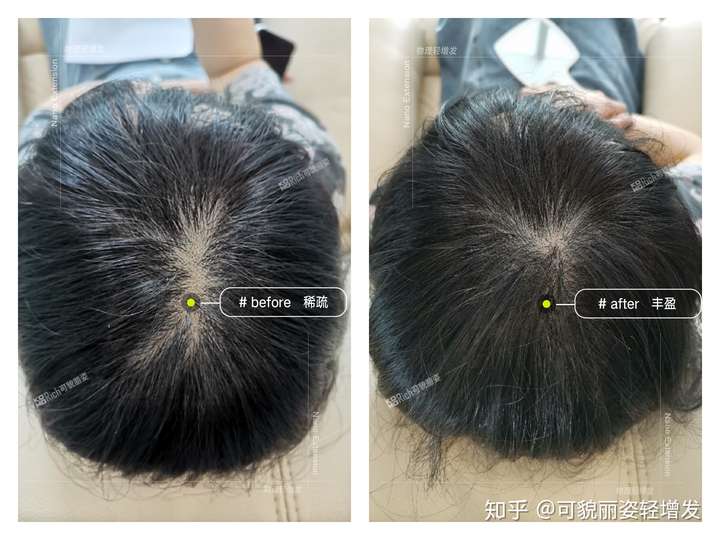 我这个发顶是要脱发了吗?