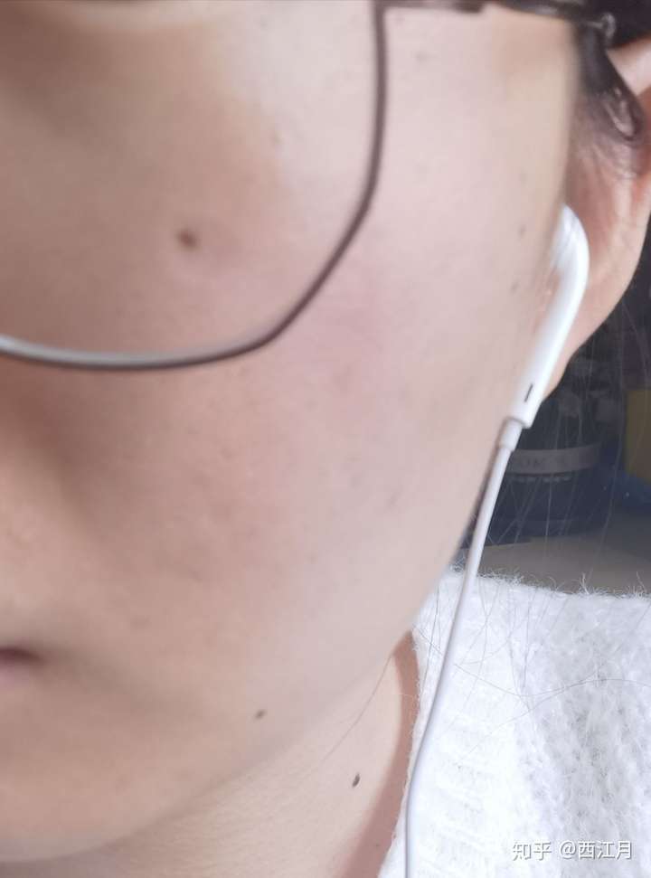 皮肤从满脸痘痘到白里透红是什么体验?