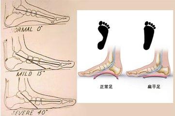 高弓足 行走疼痛易长茧高弓足与扁平足相反,走路缺点是外旋力量过大