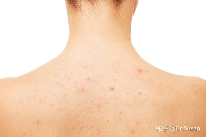 背后长痘痘要怎么办?