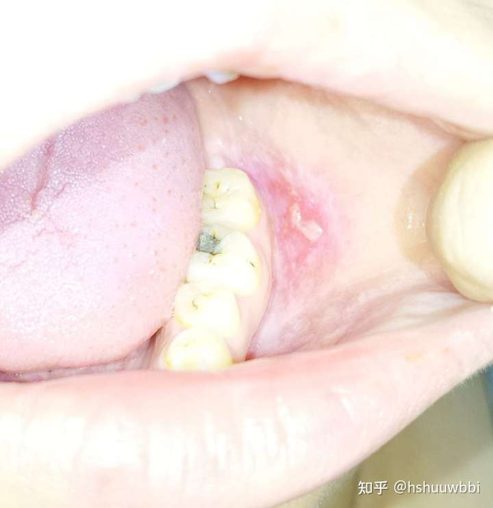 我当时一度以为是扁桃体发炎