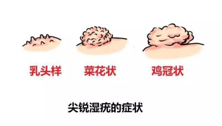 你们是怎么发现尖锐湿疣的?