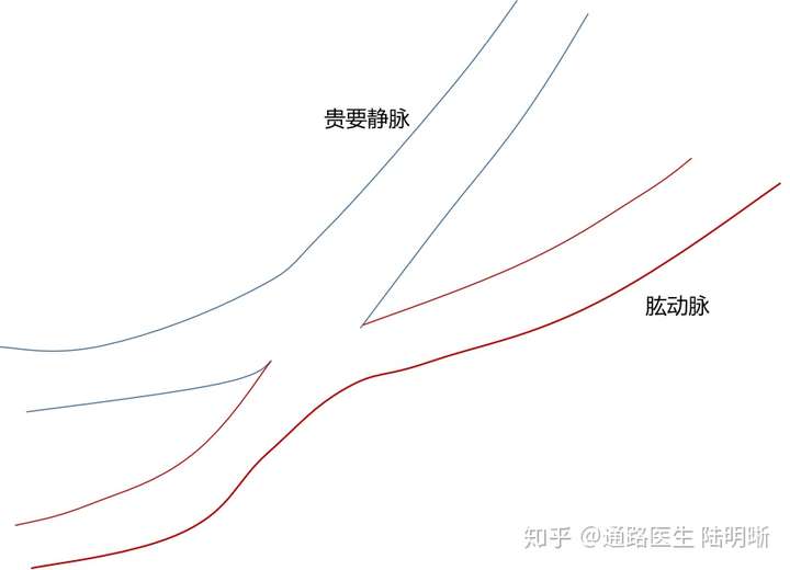 动静脉内瘘术后吻合口周囊性结构