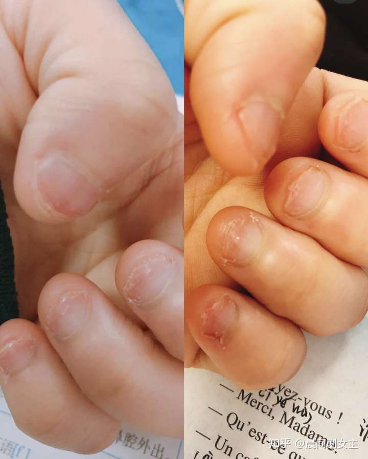 现在是过年在家隔离把手指甲抠完涂护甲油 这半个月有剪指甲因为它们