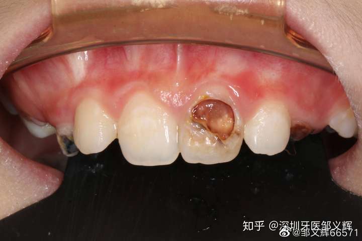 牙齿烂成这样要怎么办?