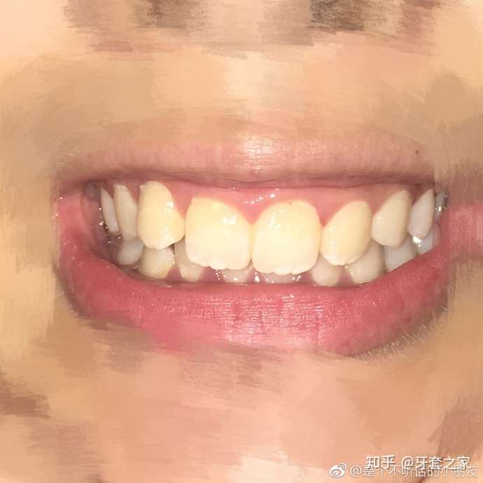 合和深覆盖,其实呢深覆盖是指上牙盖下牙在水平方向上超过正常,从侧面