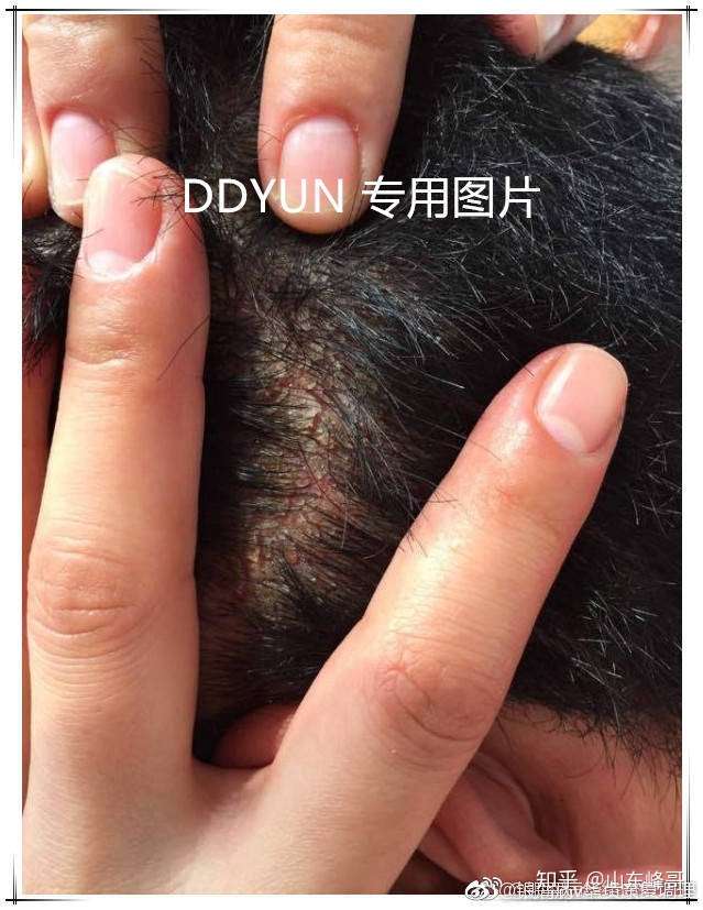 如何有效治疗头部银屑病?