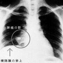肺部肿瘤