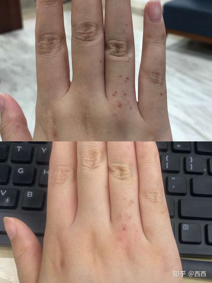 手上因为冻疮长的这些红疙瘩到底是什么东西好多年都没有消掉