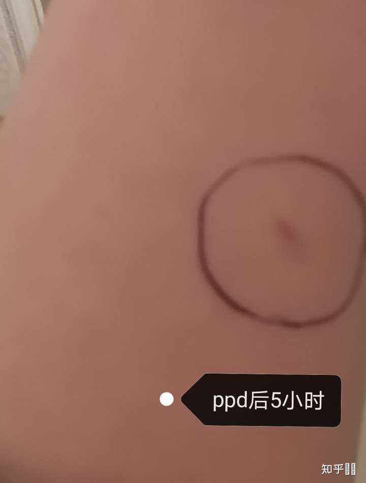 t_t 所以我不得已赶紧去做了一次ppd, 结果如下: 一般ppd24小时内变化