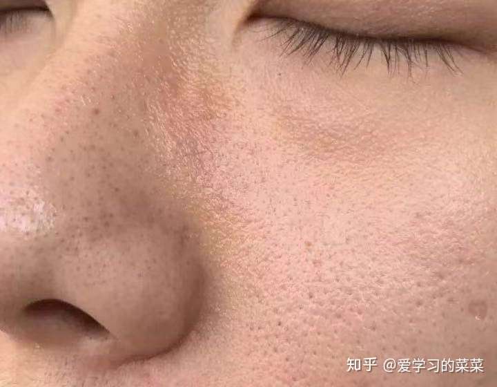 油皮毛孔粗大怎么改善