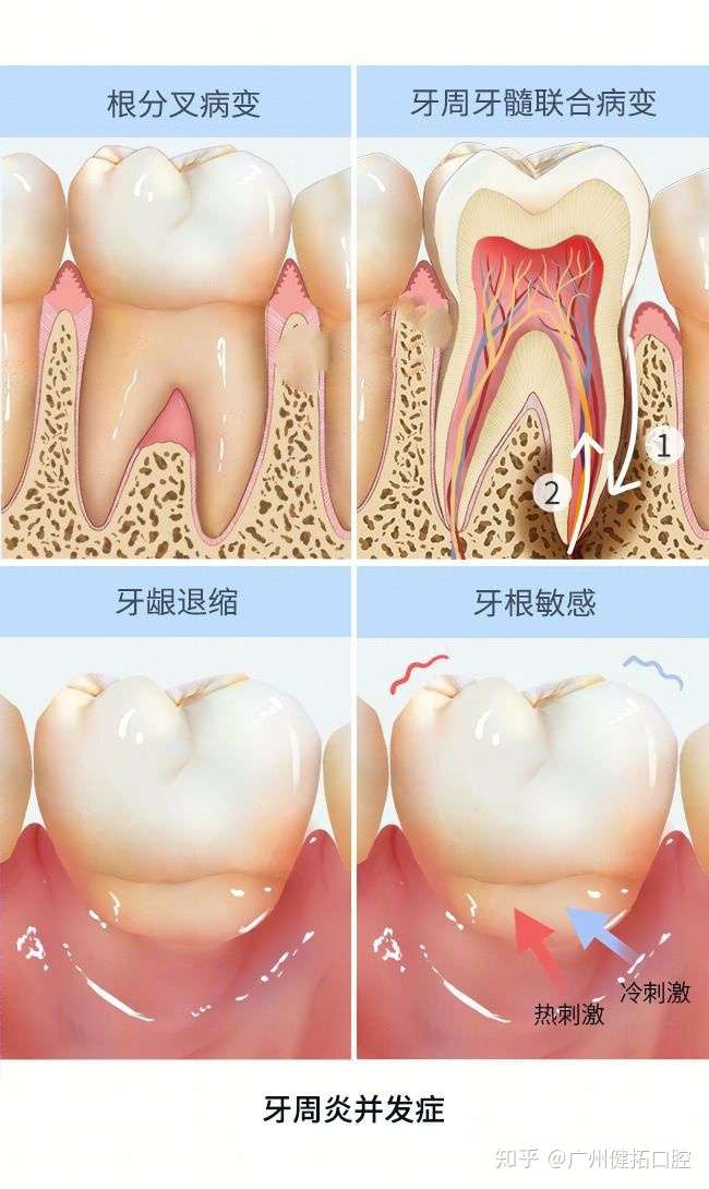 有牙周炎是一直什么样的体验?