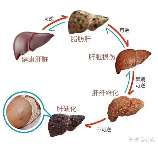 怎样才能去除脂肪肝