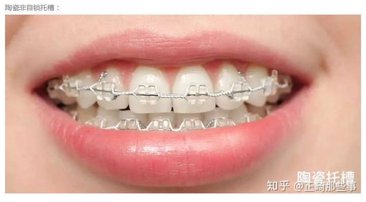 一般来说, 牙套的价格从低到高排序是:金属牙套 陶瓷牙套 隐形牙套 舌