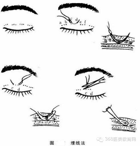 割双眼皮有什么危险吗? - 双眼皮手术