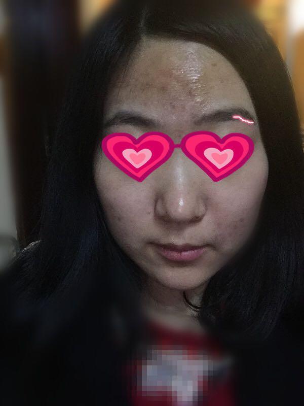 本人动漫脸上长很多痘,?-王山而的回答森女生女生系图片图片
