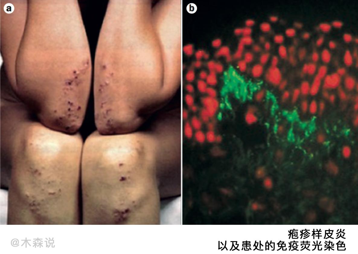 关于乳糜泻最值得看的10篇文献