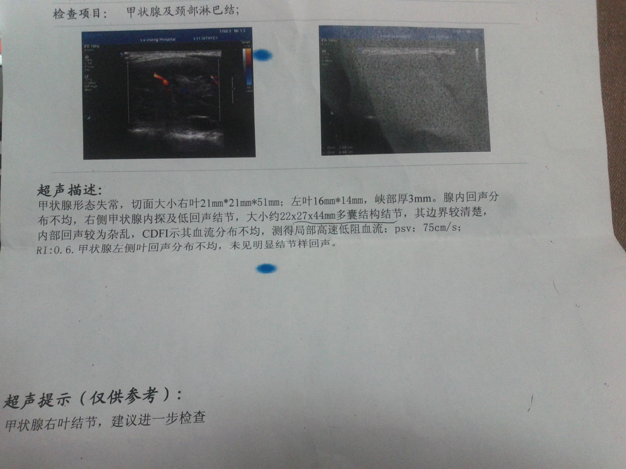 可以帮我看看这个甲状腺结节的报告吗?是良性还是恶性