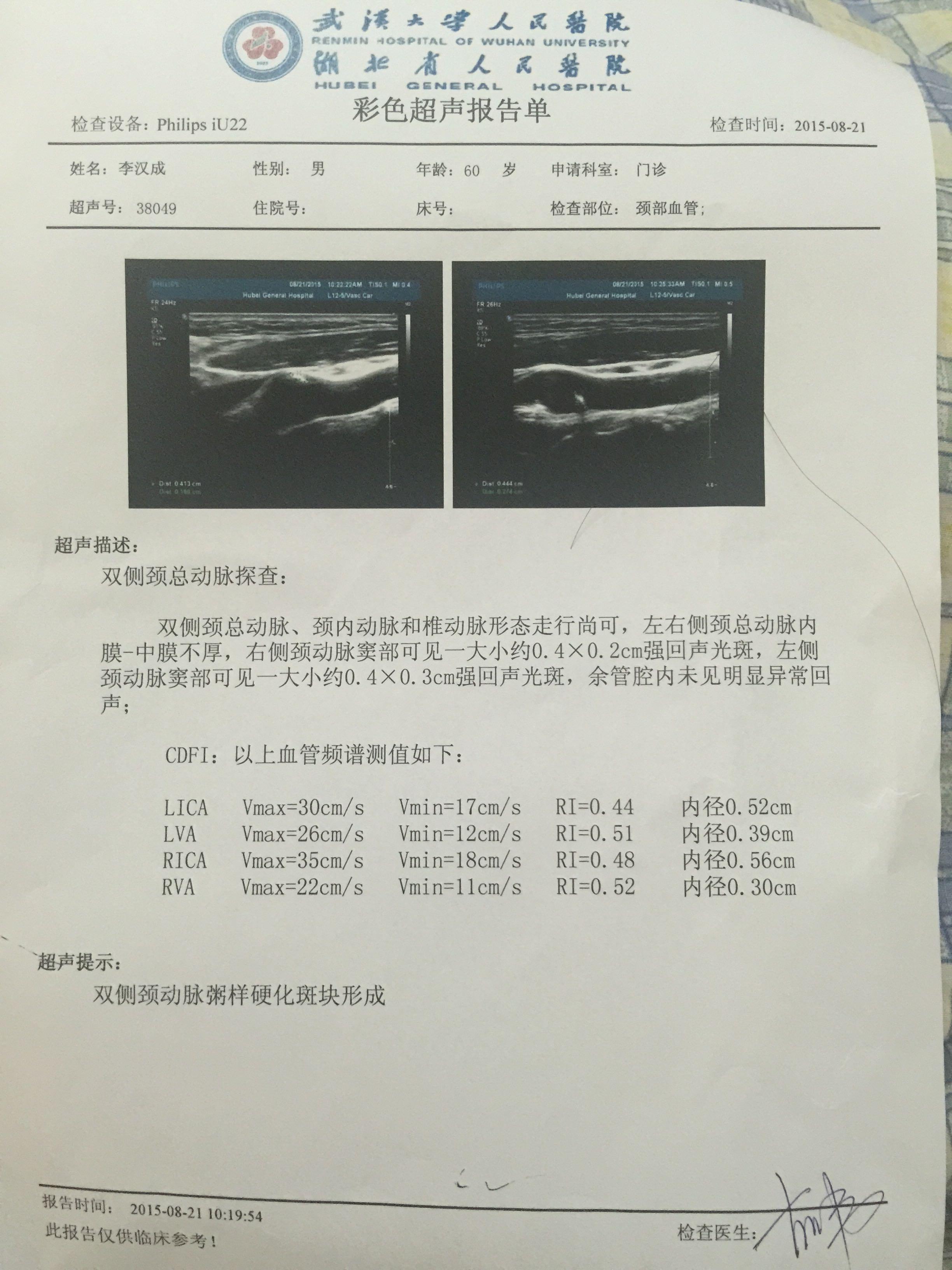 请医生帮忙看cta结果,第三条"突起"是可能有颈动脉瘤吗?