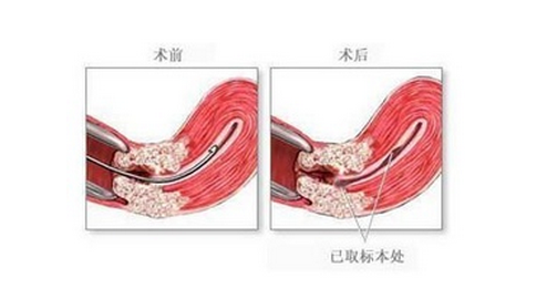 医生让我刮宫,子宫会越刮越薄吗?