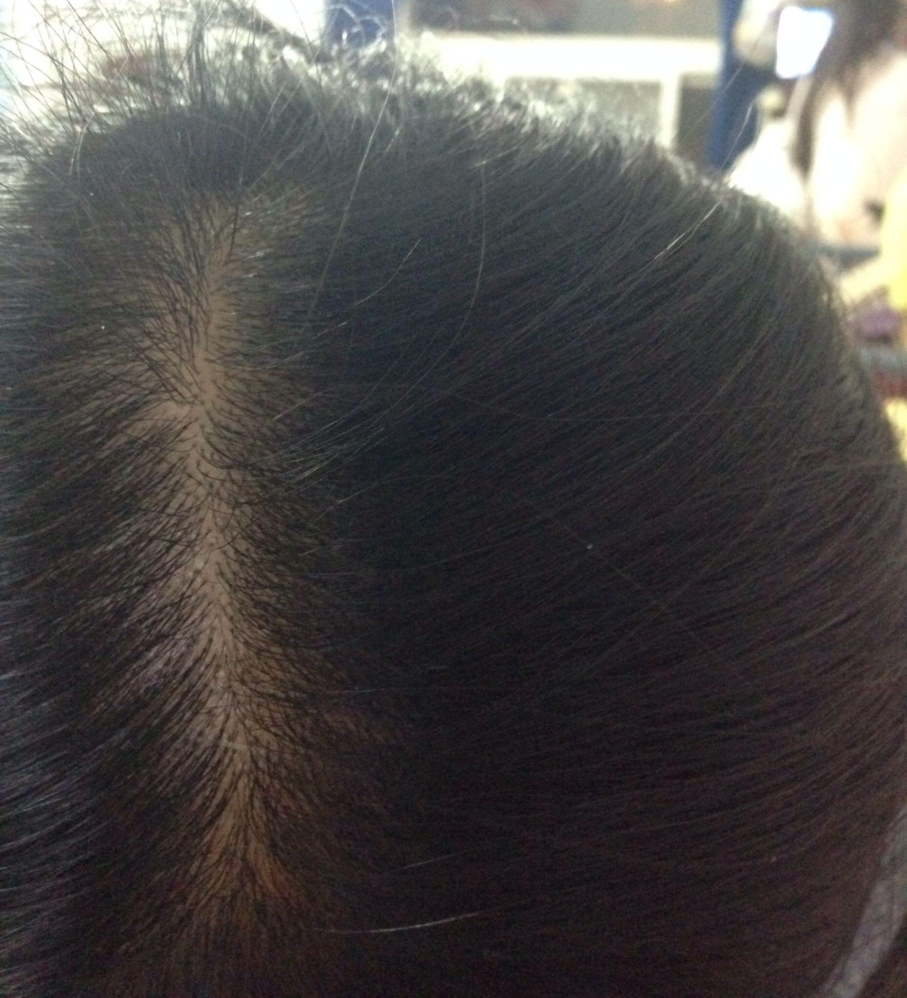 20岁<em>女生脱发</em>脱成这样怎么办。应该吃些什么
