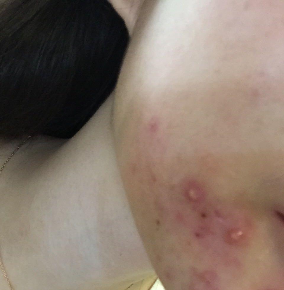 下巴长痘痘半年了 怎样都消不下去 以前不是这样的 要