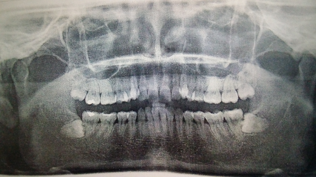 为什么图片中左下的水平阻生智齿看起来埋的不深但实际手术过程中医生